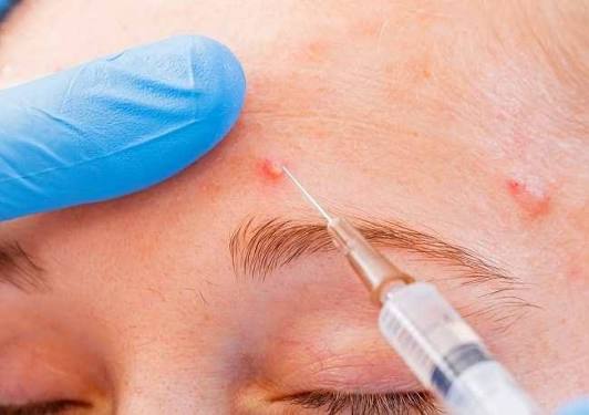 ACNE INJECTION KONDISI 3