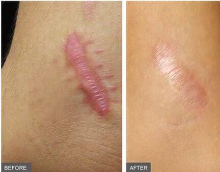 KELOID INJECTION KONDISI 2
